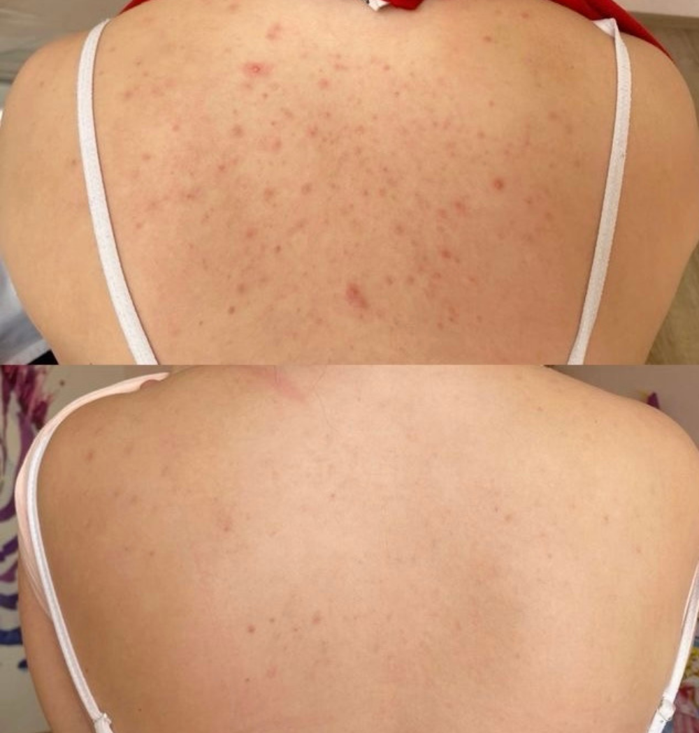 NO ACNE BUNDLE