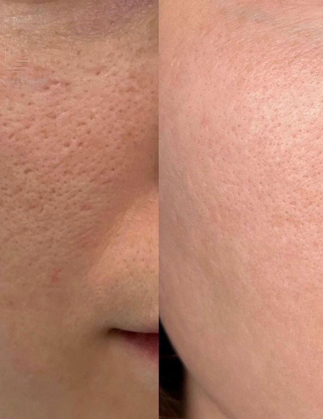 CLEAR PORES BUNDLE